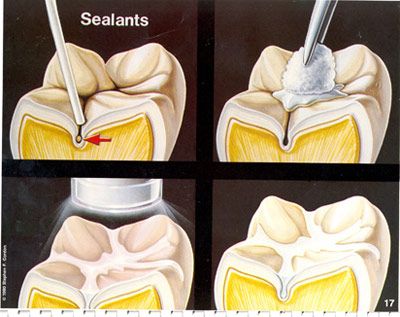 Dental Sealants, Dental Decay, Dental Anatomy, Dental Fun, Dental Facts, Dental Life, Dental Cosmetics, Dental Procedures, Pediatric Dentistry