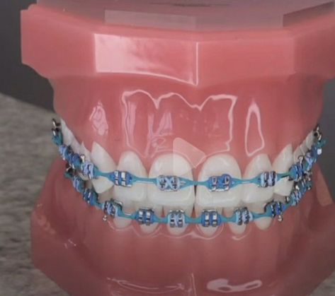 Baby Blue Braces, Braces Colors Combinations, Blue Braces, Braces Ideas, Burgundy Acrylic Nails, Cute Braces Colors, Braces Tips, Getting Braces, Cute Braces