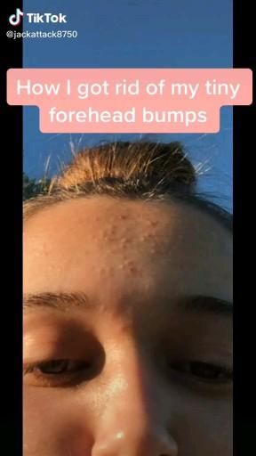 How To Clear Forehead Bumps, How To Remove Bumps On Forehead, How To Get Rid Of Bumps On Forehead, How To Get Rid Of Tiny Bumps On Forehead, Forehead Bumps Get Rid Of, Secret To Clear Skin, Why Do I Have Bumps On My Forehead, Pimple Care Routine, How To Remove Forehead Bumps