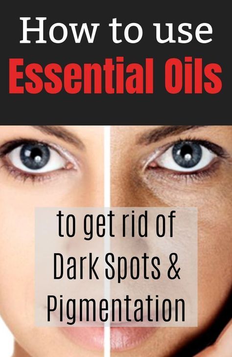 How to Use Essential Oils to Get Rid of Dark Spots & Pigmentation? Essential Oils For Face, Oily Skin Acne, Dark Spots On Face, Brown Spots Removal, Brown Spots On Face, Dark Spots On Skin, Essential Oils For Skin, Spots On Face, Remove Dark Spots