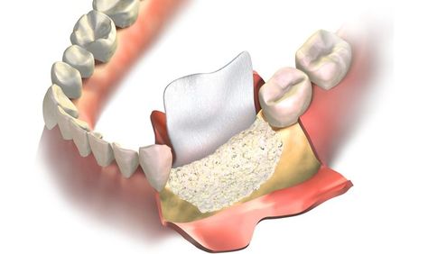 Suffering from bone deficiency but want to get your Implants for a beautiful smile transformation? Then visit our office, in Cypress, TX for Bone Grafting! Types Of Bones, Oral Maxillofacial, Bone Grafting, Oral Surgeon, Tooth Replacement, Bone Loss, Tooth Extraction, Jaw Bone, Natural Teeth