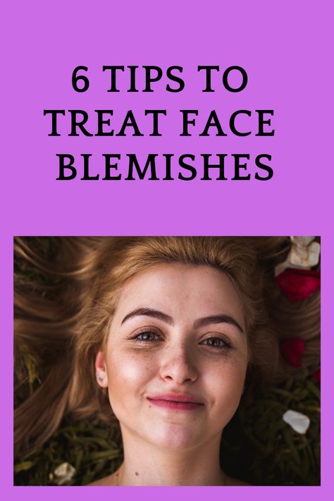 Face blemishes are common and it's uneven tone on the skin. These days acne scars or any dark patches on the skin are labelled as blemishes. If you have face blemishes and you want to have clear and fresh skin then read my post. Acne Home Remedies, Facial Tips, Beauty Tips For Face, Beauty Remedies, Fresh Skin, Skin Remedies, Cosmetics Bag, Makes You Beautiful, Health And Beauty Tips