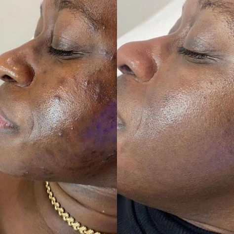 VI Peel & VI Derm (@vipeel) • Instagram photos and videos Vi Peel, Self Concept, Chemical Peel, Created By, Instagram Photos, Photo And Video, Instagram Photo, On Instagram, Quick Saves