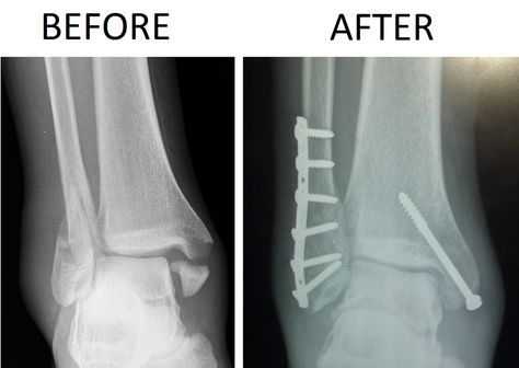 BIMALLEOLAR AND TRIMALLEOLAR FRACTURES - ACE Physical Therapy and Sports Medicine Institute Ankle Fracture Recovery, Ankle Break, What Is Cupping Therapy, Fractured Ankle, Jones Fracture, Broken Ankle Recovery, Ankle Recovery, Ankle Rehab, Types Of Fractures