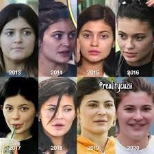 Why Fillers Are The Go-To Beauty Hack For Millennials Kylie Before Surgery, Kylie Jenner No Makeup, Kylie Jenner Makeup, Brow Lift, Name Calling, No Makeup, Look Older, Natural Face, Sagging Skin