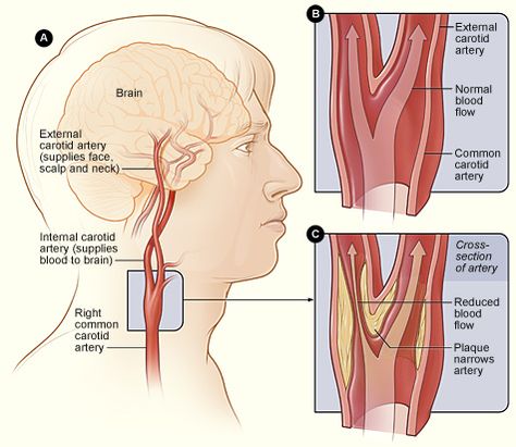 Vascular & Endovascular Surgery - Carotid Ultrasound Vascular Ultrasound, Vertebral Artery, Medical Intuitive, Carotid Artery, Nursing Care Plan, Blood Pressure Chart, Blood Pressure Diet, Normal Blood Pressure, Inflammatory Diet