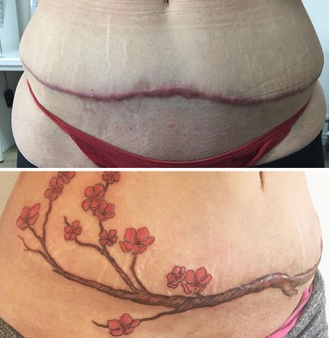 10+ Amazing Tattoos That Turn Scars Into Works Of Art Abdomen Tattoo, Tummy Tattoo, Tattoo Over Scar, Mastectomy Tattoo, Scar Cover Up, Tattoos To Cover Scars, Scar Tattoo, Tattoo Cover Up, Stomach Tattoos