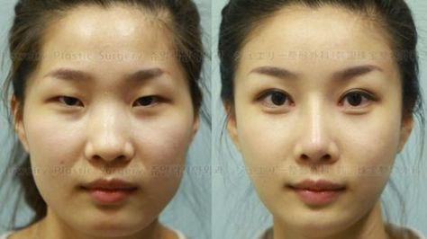 South Korean Plastic Surgeons Are Too Good At Their Job South Korean Plastic Surgery, Beauty Diy Skincare, Korean Plastic Surgery, Bigger Eyes, Beauty Hacks Skincare, Double Eyelid, Reconstructive Surgery, Eye Surgery, Nose Job