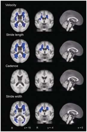 Loss of white matter integrity is associated with gait disorders in cerebral small vessel disease | Brain | Oxford Academic Brain Facts, White Matter, Migraine, Chronic Illness, Disease, Brain, Oxford, Matter, Medical