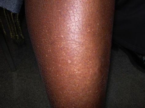 What are the white spots on my arms? What to know about 'reverse freckles' White Mole, Moles On Face, Black Head Remover Mask, Spots On Legs, Skin Moles, Skin Spots, Spots On Face, Light Spots, Remove Dark Spots