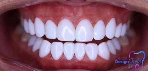 Perfect Teeth Smile, Perfect Smile Teeth, Smile Tips, Script Dr, Teeth Aesthetic, Cute Braces Colors, Pretty Teeth, Cute Braces, Veneers Teeth