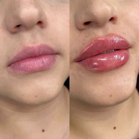 1 Ml Lip Filler, Cosmetic Web, Skin Anatomy, Lips Inspiration, Face Fillers, Wax Roller, Botox Lips, Eyebrow Makeup Tutorial, Botox Face