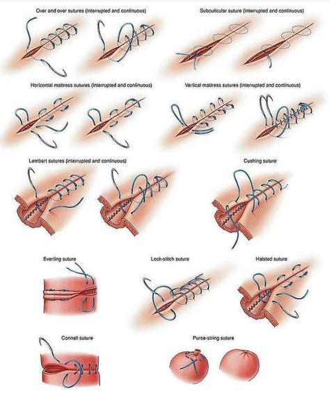 MEDICAL LIFE’s Instagram profile post: “Different types of suture technique.. . Hit the like button ❤and follow↗️ my page if you like ❤my contant.. .Mention your friends to see…” Stitches Medical, Surgical Stitches, Suture Techniques, Vet Tech School, Medical Life, Surgical Suture, Medicine Notes, Survival Ideas, Vet Medicine