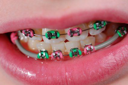 Recipes for people with braces ~ Recipes for after mouth surgery | HubPages Braces Recipes, People With Braces, Braces Friendly Recipes, Pink Braces, Braces Food, Girls With Braces, After Wisdom Teeth Removal, Kids Braces, Braces Tips