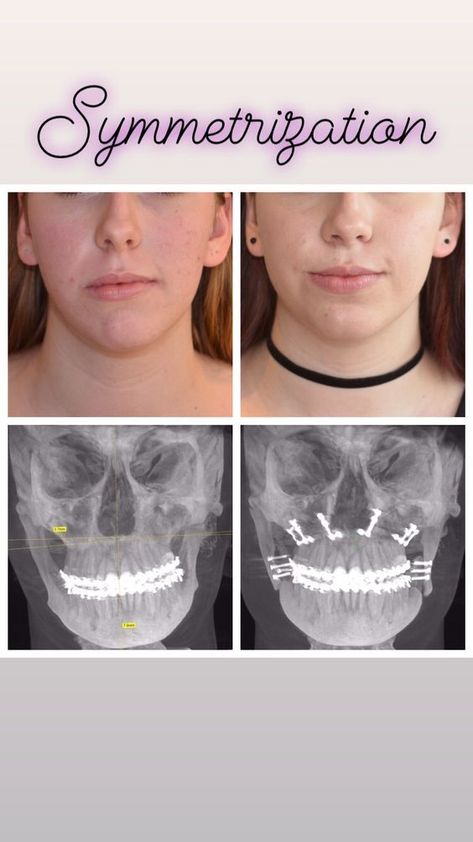 Jaw Reduction Surgery, Nose Surgery Rhinoplasty, Plastic Surgery Fail, Rhinoplasty Nose Jobs, Dental Images, Plastic Surgery Photos, Plastic Surgery Gone Wrong, Face Surgery, Cheek Fillers