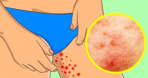 How to Fix the Problems All of Us Suffer From in the Summer Inner Thigh Chafing, Balancing Chakras, Thigh Rub, Thigh Chafing, Hill Walking, Thick Thighs Save Lives, Inner Thigh, Summer Makeup, Organic Oil