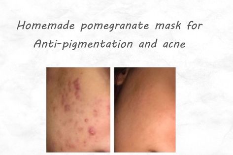 Skincare Clear Skin, Hyperpigmentation Mask, Clear Skin Care, Fungal Acne, Acne Skincare, Summer Skincare, How To Get Rid Of Acne, Glowy Skin, Diy Skin