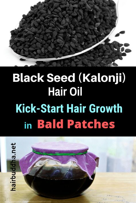 Bald Hair Growth, Scalp Hair Growth, Bald Patches, Hair Remedies For Growth, Bald Hair, New Hair Growth, Lost Hair, Black Seed, Hair Growth Oil