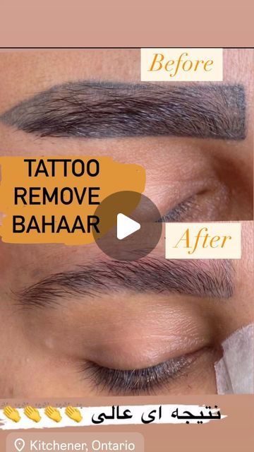 Waterloo Canada, Eyebrow Tattoo Removal, Eyebrows Tattoo, Beautiful Eyebrows, Eyebrow Tattoo, Tattoo Removal, Art Tattoo, Eyebrows, Make Your