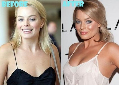 Margot Robbie Nose, Hair Implants, Sci Fi Girl, Celebrity Plastic Surgery, Celebrities Before And After, Botox Injections, Breast Surgery, After Pictures, Nose Job