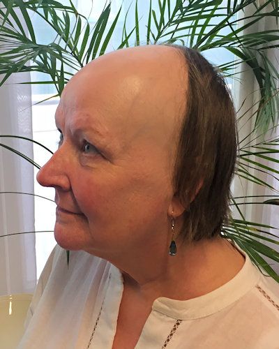 Jenny's Story of Frontl Fibrosing Alopecia - Lucinda Ellery UK Frontal Fibrosing Alopecia, Alopecia Hairstyles, Bald Head Women, Prp Hair, Eyelash Tips, Frontal Hairstyles, Bald Head, Hair Solutions, Medical Help