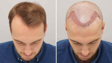 no laser hair transplants!! Female Hair Transplant, Hair Transplant Women, Hair Transplant Cost, Hair Transplant Procedure, Fue Hair Transplant, Hair Transplant Surgery, Best Hair Transplant, Hair Clinic, Female Hair