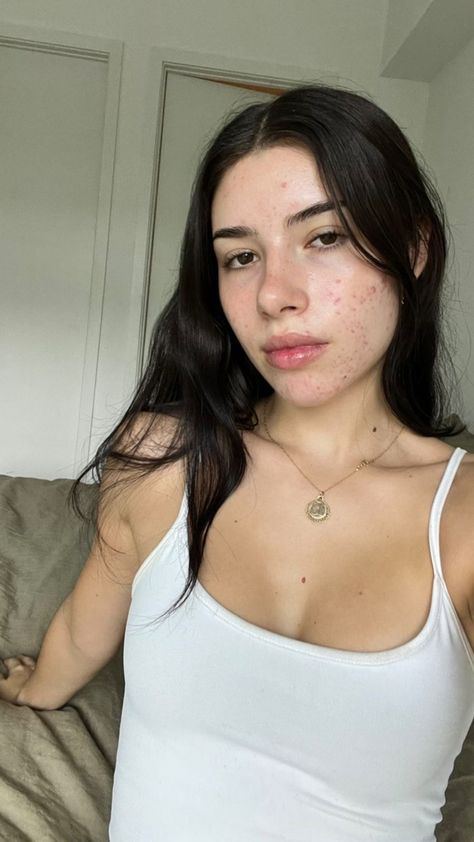 People With Acne Pretty, Acne Face Aesthetic, Beautiful Girls With Acne, Acne No Makeup Look, Natural Acne Makeup, Clean Girl With Acne, Acne Aesthetic Girl, Acne Girls Pretty, Bad Acne Pictures