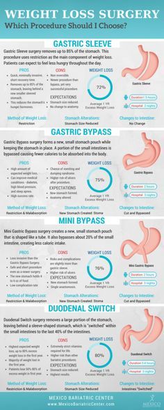 Bariatric Diet, Sleeve Surgery, Lose 50 Pounds, Kombucha, Lose Belly Fat, Different Types, Surgery, Massage, Diet