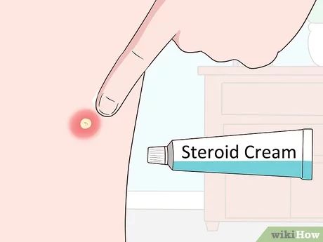 3 Ways to Remove an Ingrown Hair - wikiHow Ingrown Hair Under Armpit, Ingrown Hair Armpit, Vegan Probiotics, Ingrown Hair Removal, Prevent Ingrown Hairs, Ingrown Hairs, Hair Curls, Back Pain Exercises, Ingrown Hair