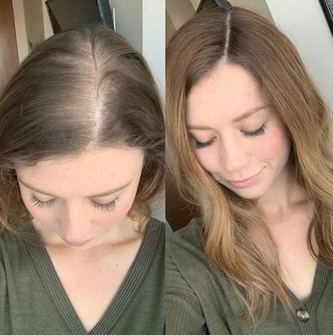 Alopecia Fashionista : Nous devons être fières de porter des cheveux ! (même d'une autre) Female Hair, Greasy Hair Hairstyles, Thinning Hair, Hair Stuff, Hair Fibers, Beauty Recipe, Hair Routines, Hair Care Routine, Hair Care Tips