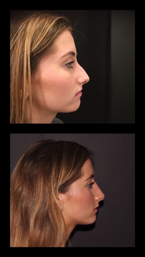 Nose Job Before And After Bump, Non Surgical Nose Job Before After, Nose Injections Before And After, Filler Nose Job Before After, Nose Job Before And After Front View, Botox Nose Before After, Nose Before And After, Liquid Nose Job Before And After, Nose Job Before And After Rhinoplasty