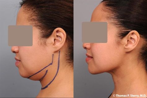 Photo Gallery - Smartlipo™ Neck Liposuction in NYC - Dr. Sterry Double Chin Surgery, Lipo Before And After, Medical Website Design, Face Fillers, Double Menton, Laser Lipo, Neck Surgery, Diet And Exercise, Henna Designs Hand