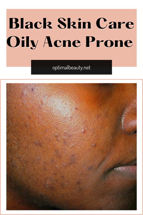 skin care, skin care routine, skin care homemade, skincare essentials, facial, best acne products, clear skin, dark spots, acne, skincare tips, how to get clear skin, glowy skin, acne skincare routine, products, for black women Skincare Routine Products, Facial Care Routine, Oily Skin Remedy, Homemade Skincare, Acne Products, Best Acne Products, Oily Skin Acne, Oily Skin Care Routine, Oily Face