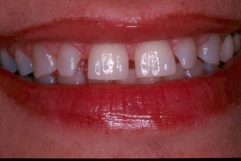 Gaps between teeth Gaps In Teeth, Gap In Teeth, People With Gaps In Their Teeth, Teeth With Gap, Gap Tooth, Teeth Gap, Essential Oils For Pregnancy, Gap Teeth, Maternity Chic