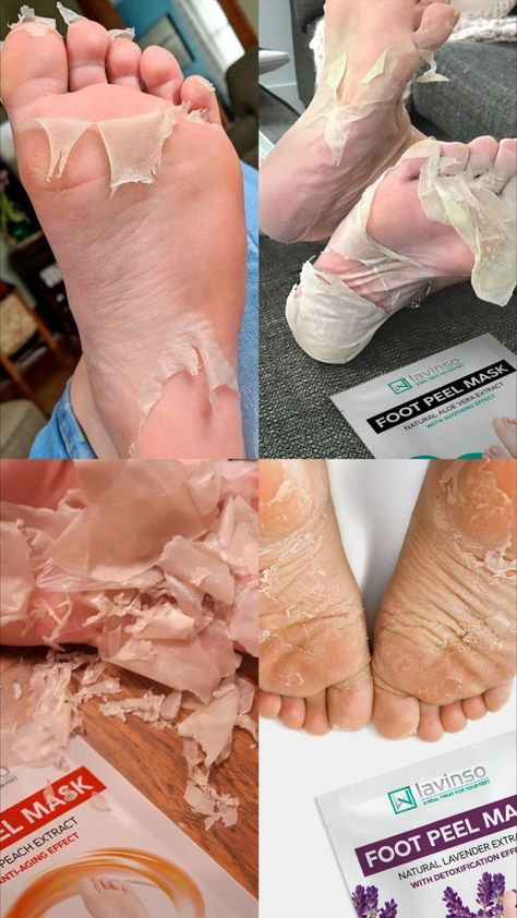 lavinso foot peel mask remove dead skin Foot Peel Mask, Coldsore Remedies Quick, Peeling Mask, Skin Natural Remedies, Cold Sores Remedies, Hormonal Balance, Foot Mask, Natural Sleep Remedies, Natural Cold Remedies