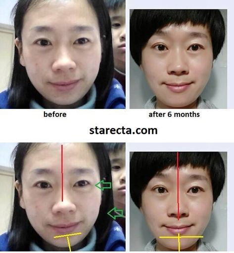 How to develop, widen and make your face more symmetrical Non Symmetrical Face, How To Symmetrical Face, Aysemetrical Face, Face Assymetry Exercise, How To Get A More Symmetrical Face, How To Make Face More Symmetrical, Facial Assymetry Exercises, How To Make Your Face More Symmetrical, How To Fix Face Symmetry