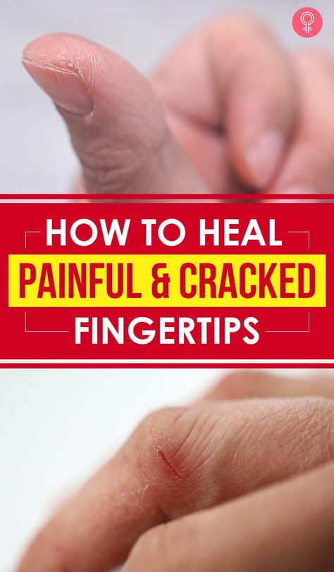 Dry Cracked Hands Remedy, Cracked Hands Remedy, Cracked Fingertips, Dry Hands Remedy, Cracked Fingers, Dry Cracked Hands, Chapped Hands, Cracked Hands, Health Signs