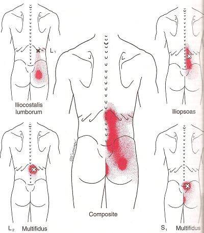 Learn about the most common low back pain trigger points and how you might prevent and treat them Punkty Spustowe, Bolesti Chrbta, Trigger Point Therapy, Psoas Muscle, Trigger Point, Sciatic Nerve Pain, Sciatica Pain, Sciatic Nerve, Back Pain Exercises