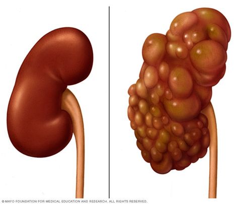 Polycystic kidney compared with normal kidney Polycystic Kidneys, Kidney Detox, Kidney Damage, Disease Symptoms, Kidney Health, Stevia, Healthy Life, Disease, Nutrition