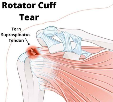 Top 6 Shoulder Rotator Cuff Exercises for Beginners Shoulder Tear Exercises, Exercises For Injured Shoulder, Shoulder Rotator Cuff Exercises, Rotator Cuff Tear Exercises, Rotary Cuff Exercises, Shoulder Pt Exercises, Exercises For Rotator Cuff Pain, Shoulder Physical Therapy Exercises, Rotator Cuff Exercises Physical Therapy