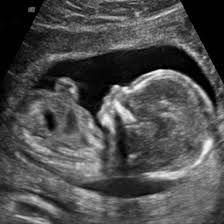 Baby Ultrasound Pictures, Obstetric Ultrasound, Ultrasound Sonography, Baby Weeks, Pregnancy Ultrasound, Baby Ultrasound, Baby Scan, Ultrasound Pictures, Fetal Development