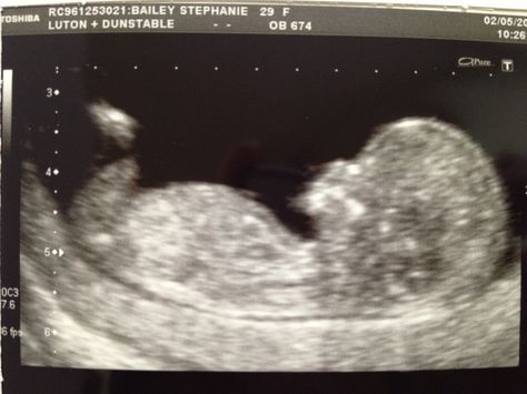 12 week scan! 12 Week Scan, 6 Month Baby, 12 Weeks, Ultrasound, Baby Month By Month, 6 Months, Quick Saves