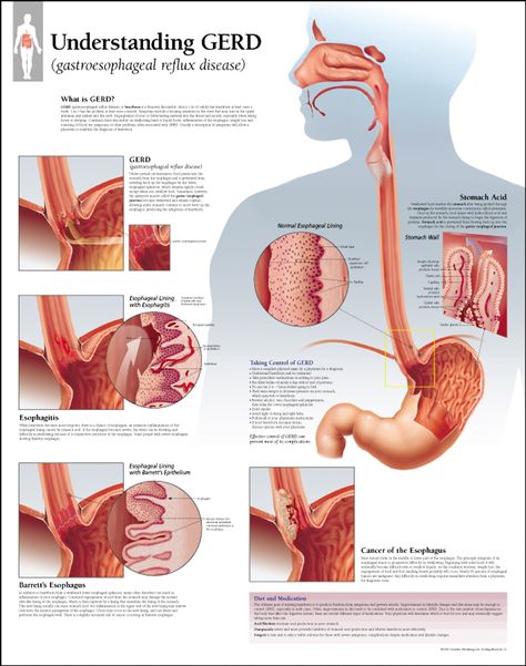 Understanding GERD / Scientific Publishing What Is Gerd, Reflux Remedies, Reflux Baby, Gerd Symptoms, Gerd Diet, Asam Lambung, Acid Indigestion, Stop Acid Reflux, Acid Reflux Recipes