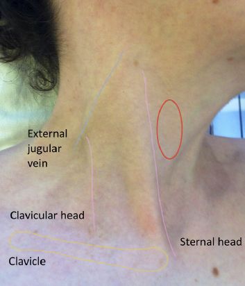 Interpreting JVP Jugular Venous Pressure, Cardiac Nursing, Medical Terminology, Cardiology, Assessment, Cardio, Nursing, Medicine, Matter