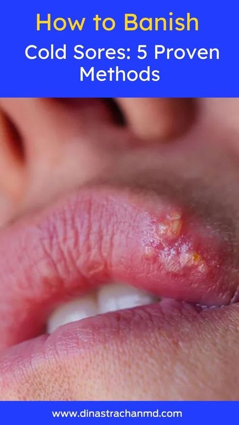 Discover 5 effective ways to treat and prevent cold sores. Learn about over-the-counter remedies, prescription options, and lifestyle changes for faster healing. Quick Cold Sore Remedy, How To Prevent Cold Sores, Cold Sores On Lips, Home Remedy For Cold Sore On Lip, Cold Sores Remedies Overnight, Home Remedies For Cold Sores, How To Get Rid Of A Cold Sore Fast, How To Get Rid Of Cold Sores, Coldsore Remedies Overnight