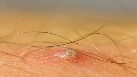 Ingrown Hair on Butt: Symptoms, Causes, Remedies Ingrown Hair Removal Videos, Skin Boil, Infected Ingrown Hair, Ingrown Hair Remedies, Bump Hairstyles, Ingrown Hair Removal, Face Wrinkles, Acupressure Points, Hair Remedies