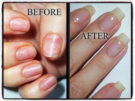 My Nail Journey-Growing Natural Nails after damage from Acrylics/Gels (+... Great natural remedies for healthy nails. Natural Looking Acrylic Nails, Nails After Acrylics, Nails Opi, Nails Yellow, Damaged Nails, How To Grow Nails, Nail Growth, Nails Polish, Nail Strengthener