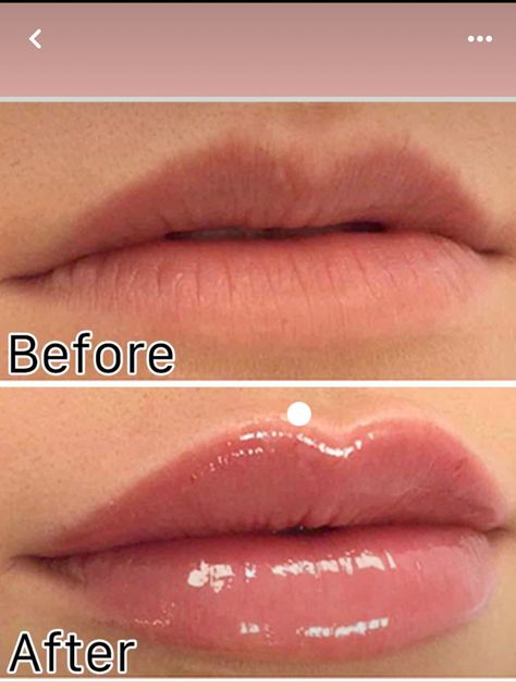 Full Lips Makeup, Facial Injections, Cosmetic Injections, Lips Fillers, Lip Flip, Lip Permanent Makeup, Heart Shaped Lips, Permanente Make-up, Lips Inspiration