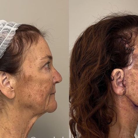 Dr. L. Mike Nayak on Instagram: "Just one day after surgery. In addition to a #deepplanefacelift, Lauran also had a #deepnecklift, #browlift, #earloberedction, #fattransfer to the face, and correction of a droopy chin. This technique is a complete paradigm shift from extensive “delamination” to performing a true, extended deep plane facelift with less than half of the skin dissection traditionally required. You could call it “preservation” deep plane facelifting. With this technique, recov Facelift Recovery Day By Day, Nose Thread Lift Before And After, Deep Plane Facelift, Pdo Thread Lift Before And After Face, Deep Plane Facelift Before And After, Fox Eye Lift Surgery, Facelift Before And After, Facelift Procedure, Fat Transfer