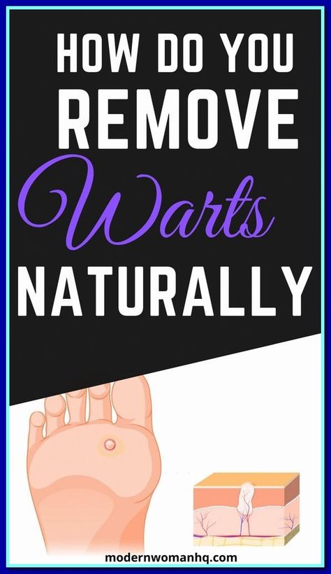 Board name What Causes Warts, Remove Warts, Cold Medicine, Get Rid Of Warts, Home Remedy For Cough, Cold Sores Remedies, Natural Sleep Remedies, Natural Cold Remedies, Cold Home Remedies